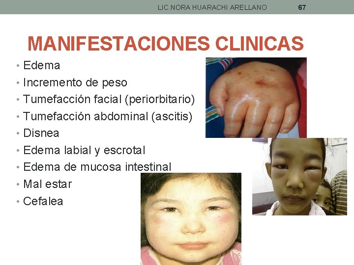 LIC. NORA HUARACHI ARELLANO 67 MANIFESTACIONES CLINICAS • Edema • Incremento de peso •
