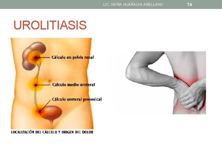 LIC. NORA HUARACHI ARELLANO UROLITIASIS 74 