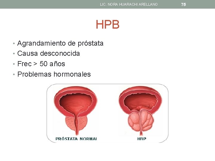 LIC. NORA HUARACHI ARELLANO HPB • Agrandamiento de próstata • Causa desconocida • Frec