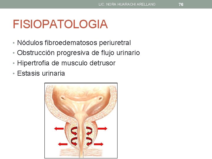 LIC. NORA HUARACHI ARELLANO FISIOPATOLOGIA • Nódulos fibroedematosos periuretral • Obstrucción progresiva de flujo