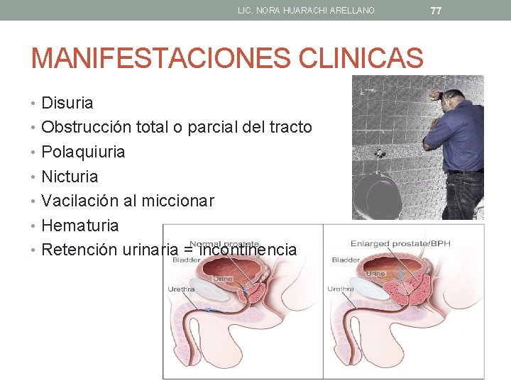 LIC. NORA HUARACHI ARELLANO MANIFESTACIONES CLINICAS • Disuria • Obstrucción total o parcial del