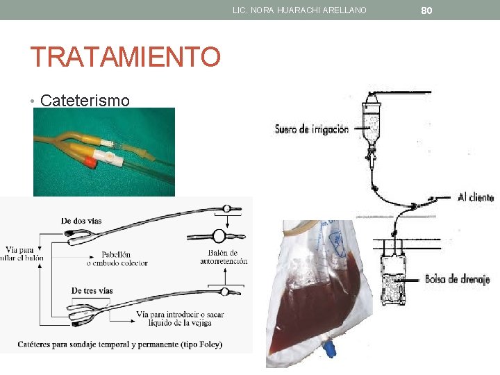 LIC. NORA HUARACHI ARELLANO TRATAMIENTO • Cateterismo 80 