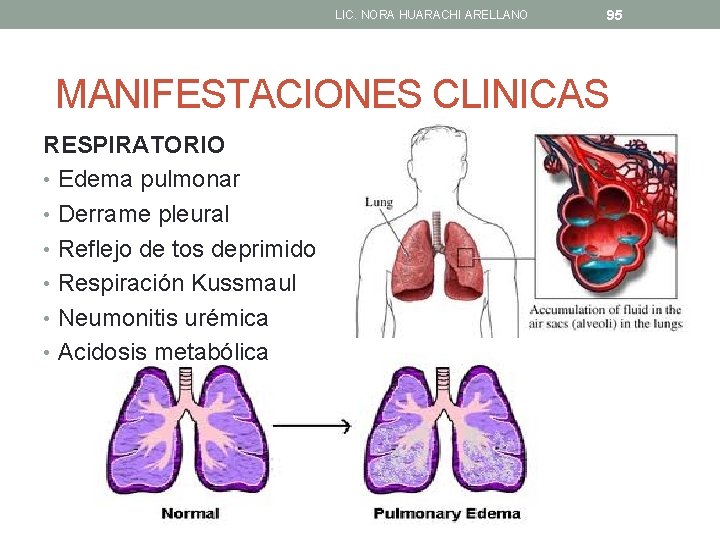 LIC. NORA HUARACHI ARELLANO 95 MANIFESTACIONES CLINICAS RESPIRATORIO • Edema pulmonar • Derrame pleural