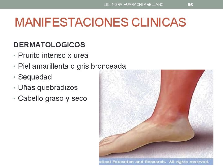 LIC. NORA HUARACHI ARELLANO MANIFESTACIONES CLINICAS DERMATOLOGICOS • Prurito intenso x urea • Piel