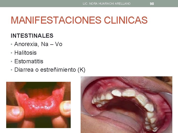 LIC. NORA HUARACHI ARELLANO MANIFESTACIONES CLINICAS INTESTINALES • Anorexia, Na – Vo • Halitosis