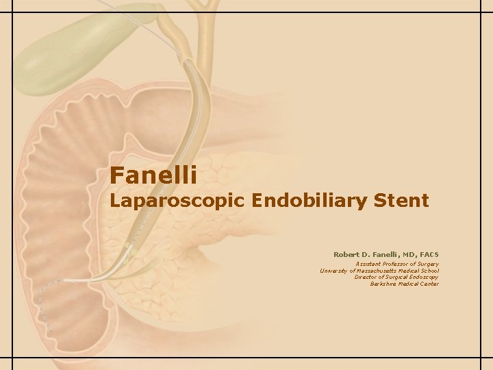 Fanelli Laparoscopic Endobiliary Stent Robert D. Fanelli, MD, FACS Assistant Professor of Surgery University