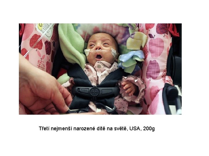 Třetí nejmenší narozené dítě na světě, USA, 200 g 