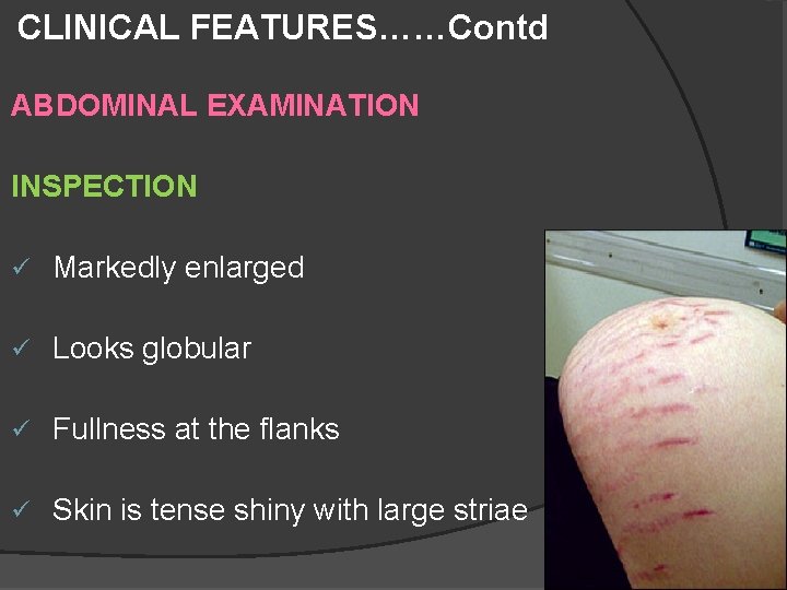 CLINICAL FEATURES……Contd ABDOMINAL EXAMINATION INSPECTION ü Markedly enlarged ü Looks globular ü Fullness at CLINICAL FEATURES……Contd ABDOMINAL EXAMINATION INSPECTION ü Markedly enlarged ü Looks globular ü Fullness at
