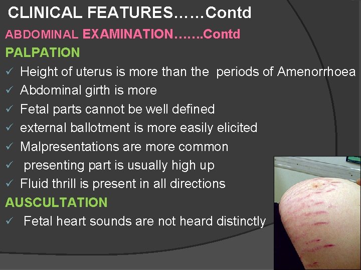 CLINICAL FEATURES……Contd ABDOMINAL EXAMINATION……. Contd PALPATION ü Height of uterus is more than the CLINICAL FEATURES……Contd ABDOMINAL EXAMINATION……. Contd PALPATION ü Height of uterus is more than the