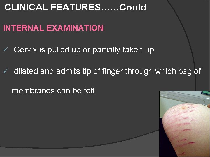 CLINICAL FEATURES……Contd INTERNAL EXAMINATION ü Cervix is pulled up or partially taken up ü CLINICAL FEATURES……Contd INTERNAL EXAMINATION ü Cervix is pulled up or partially taken up ü