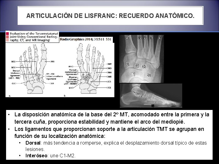 ARTICULACIÓN DE LISFRANC: RECUERDO ANATÓMICO. • La disposición anatómica de la base del 2º