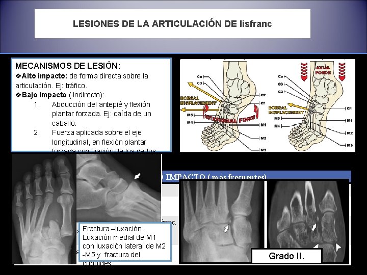 LESIONES DE LA ARTICULACIÓN DE lisfranc MECANISMOS DE LESIÓN: v. Alto impacto: de forma