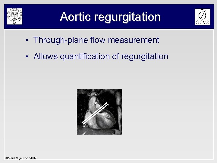 Aortic regurgitation • Through-plane flow measurement • Allows quantification of regurgitation © Saul Myerson