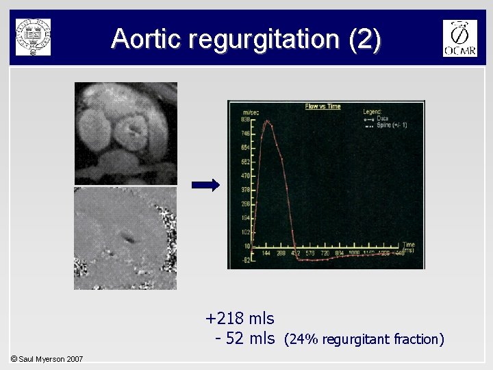 Aortic regurgitation (2) +218 mls - 52 mls (24% regurgitant fraction) © Saul Myerson