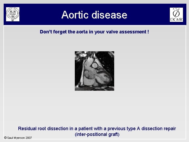 Aortic disease Don’t forget the aorta in your valve assessment ! Residual root dissection