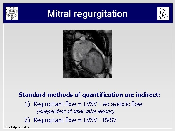 Mitral regurgitation Standard methods of quantification are indirect: 1) Regurgitant flow = LVSV -
