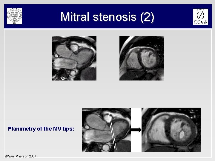 Mitral stenosis (2) Planimetry of the MV tips: © Saul Myerson 2007 