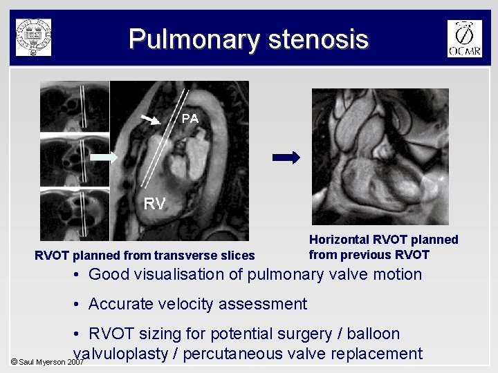 Pulmonary stenosis RVOT planned from transverse slices Horizontal RVOT planned from previous RVOT •