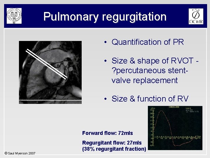 Pulmonary regurgitation • Quantification of PR • Size & shape of RVOT ? percutaneous