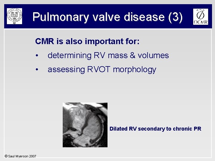 Pulmonary valve disease (3) CMR is also important for: • determining RV mass &