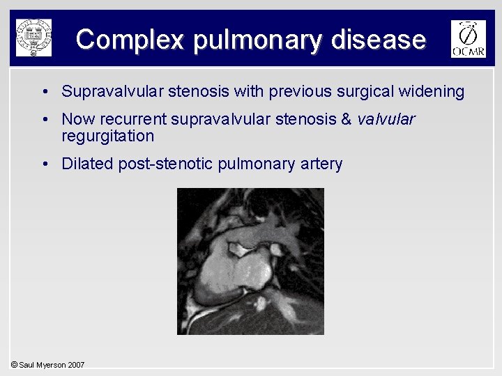 Complex pulmonary disease • Supravalvular stenosis with previous surgical widening • Now recurrent supravalvular