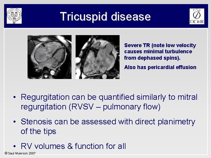 Tricuspid disease Severe TR (note low velocity causes minimal turbulence from dephased spins). Also