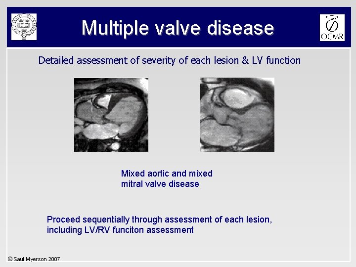 Multiple valve disease Detailed assessment of severity of each lesion & LV function Mixed