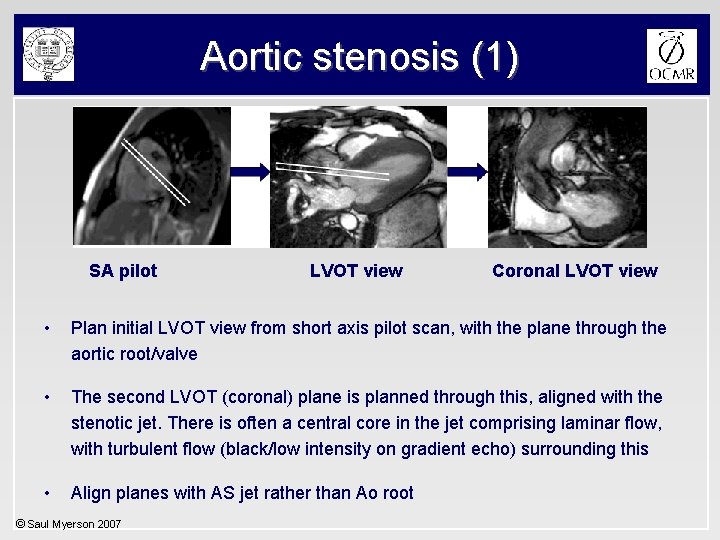 Aortic stenosis (1) SA pilot LVOT view Coronal LVOT view • Plan initial LVOT