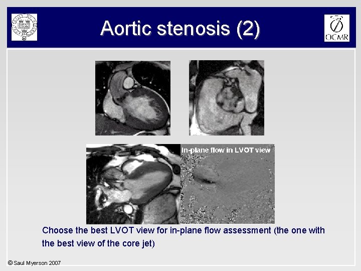 Aortic stenosis (2) Choose the best LVOT view for in-plane flow assessment (the one