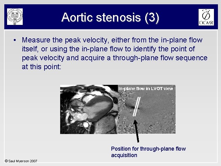 Aortic stenosis (3) • Measure the peak velocity, either from the in-plane flow itself,