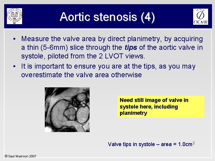 Aortic stenosis (4) • Measure the valve area by direct planimetry, by acquiring a