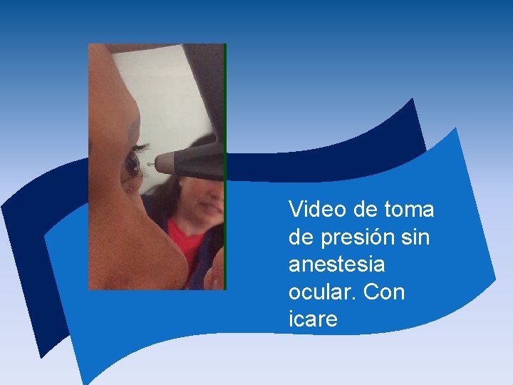 Video de toma de presión sin anestesia ocular. Con icare 