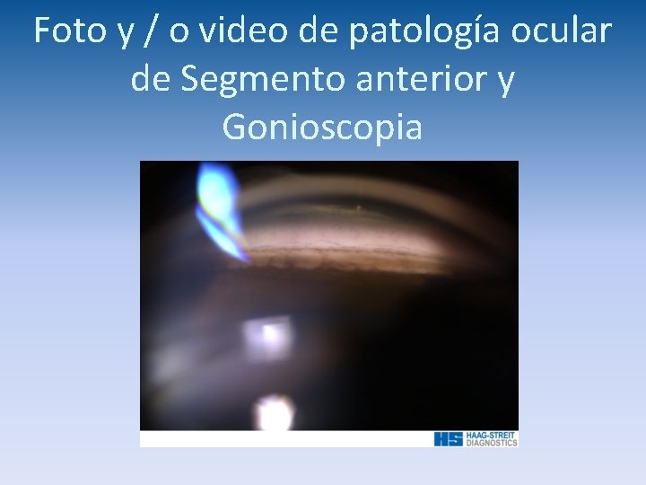 Foto y / o video de patología ocular de Segmento anterior y Gonioscopia 