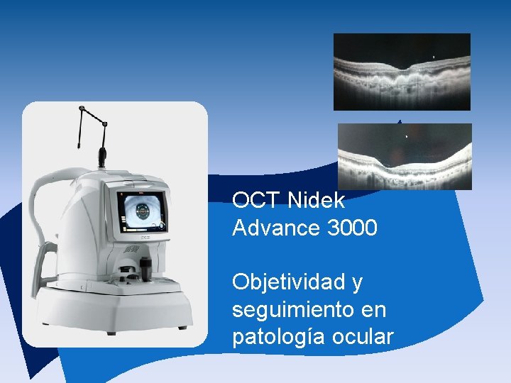 OCT Nidek Advance 3000 Objetividad y seguimiento en patología ocular 