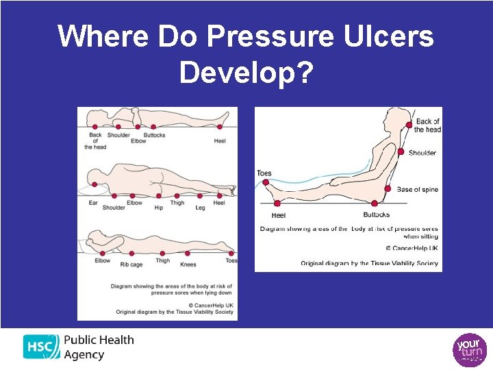 Where Do Pressure Ulcers Develop? Where Do Pressure Ulcers Develop?