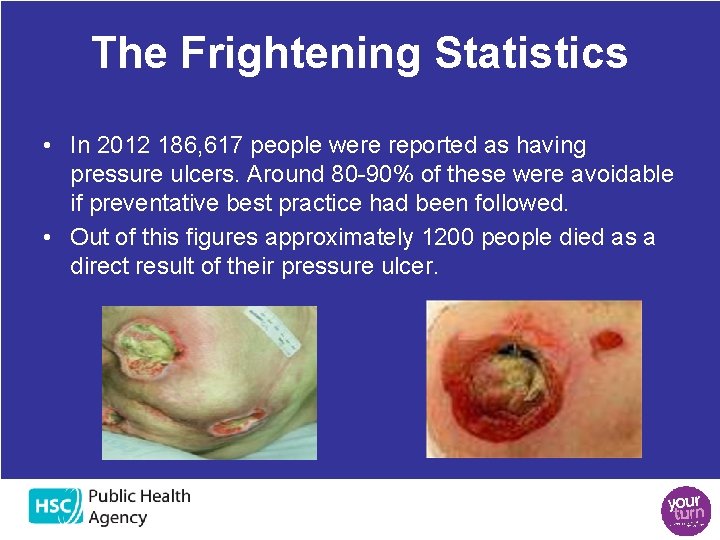 The Frightening Statistics • In 2012 186, 617 people were reported as having pressure