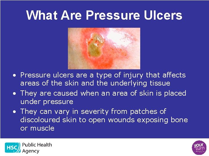 What Are Pressure Ulcers • Pressure ulcers are a type of injury that affects