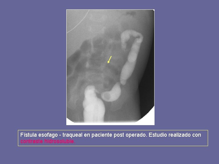 Fístula esofago - traqueal en paciente post operado. Estudio realizado contraste hidrosoluble. 