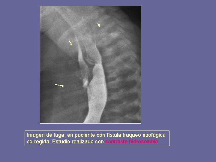 Imagen de fuga, en paciente con fístula traqueo esofágica corregida. Estudio realizado contraste hidrosoluble