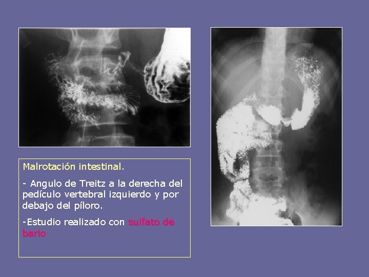 Malrotación intestinal. - Angulo de Treitz a la derecha del pedículo vertebral izquierdo y