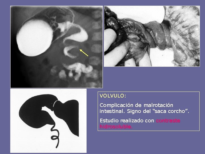 VOLVULO: Complicación de malrotación intestinal. Signo del “saca corcho”. Estudio realizado contraste hidrosoluble. 