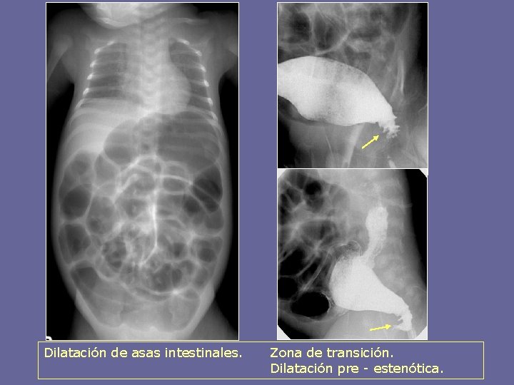 Dilatación de asas intestinales. Zona de transición. Dilatación pre - estenótica. 