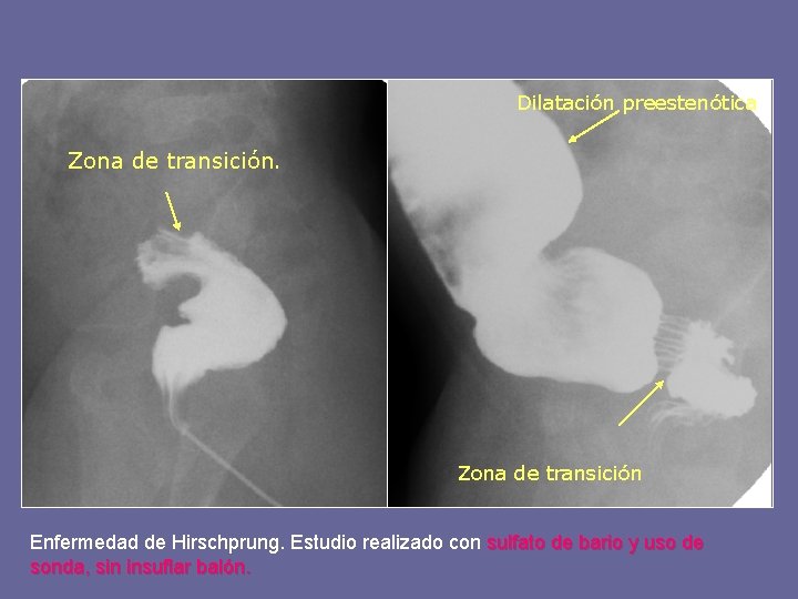 Dilatación preestenótica Zona de transición Enfermedad de Hirschprung. Estudio realizado con sulfato de bario