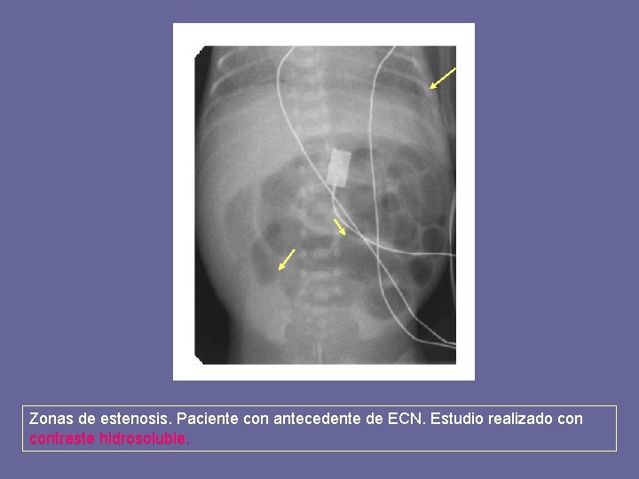 Zonas de estenosis. Paciente con antecedente de ECN. Estudio realizado contraste hidrosoluble. 