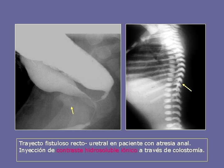 Trayecto fistuloso recto- uretral en paciente con atresia anal. Inyección de contraste hidrosoluble iónico