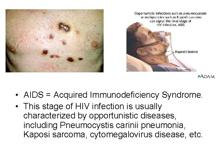  • AIDS = Acquired Immunodeficiency Syndrome. • This stage of HIV infection is