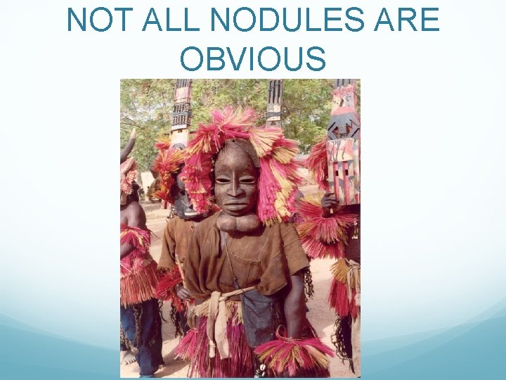 NOT ALL NODULES ARE OBVIOUS 