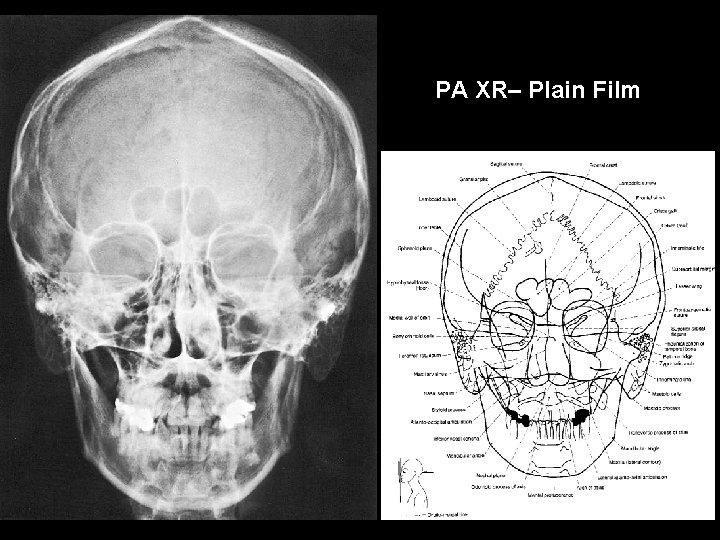 PA XR– Plain Film 