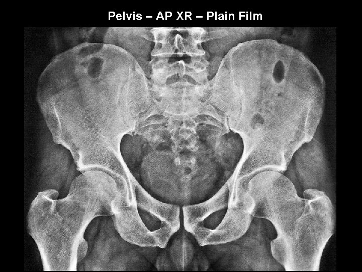Pelvis – AP XR – Plain Film 