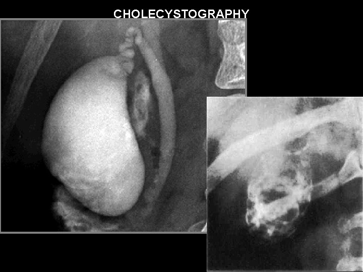 CHOLECYSTOGRAPHY 